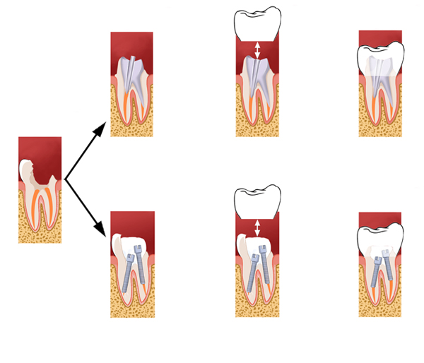 Les couronnes dentaires 1_bis